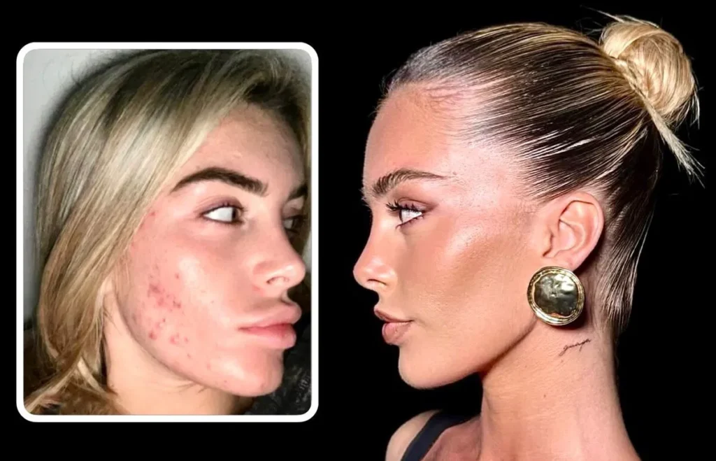 Sophie Codegoni elimina il filler alle labbra 2