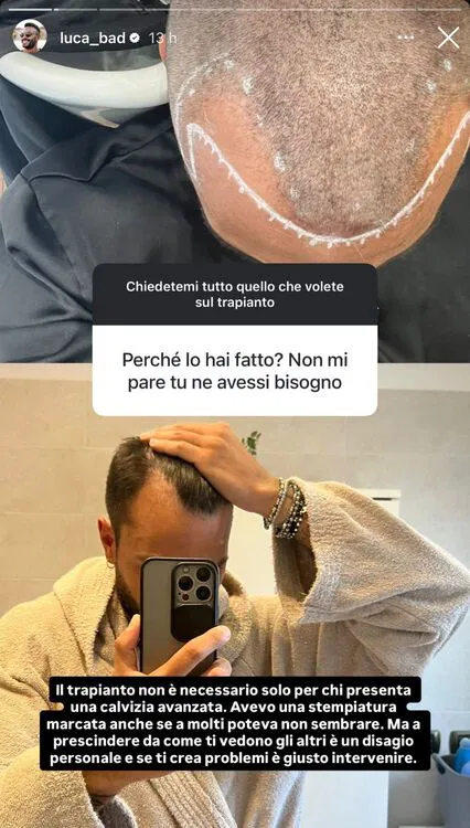 Temptation Island, ex protagonista si è sottoposto ad un trapianto di capelli 3