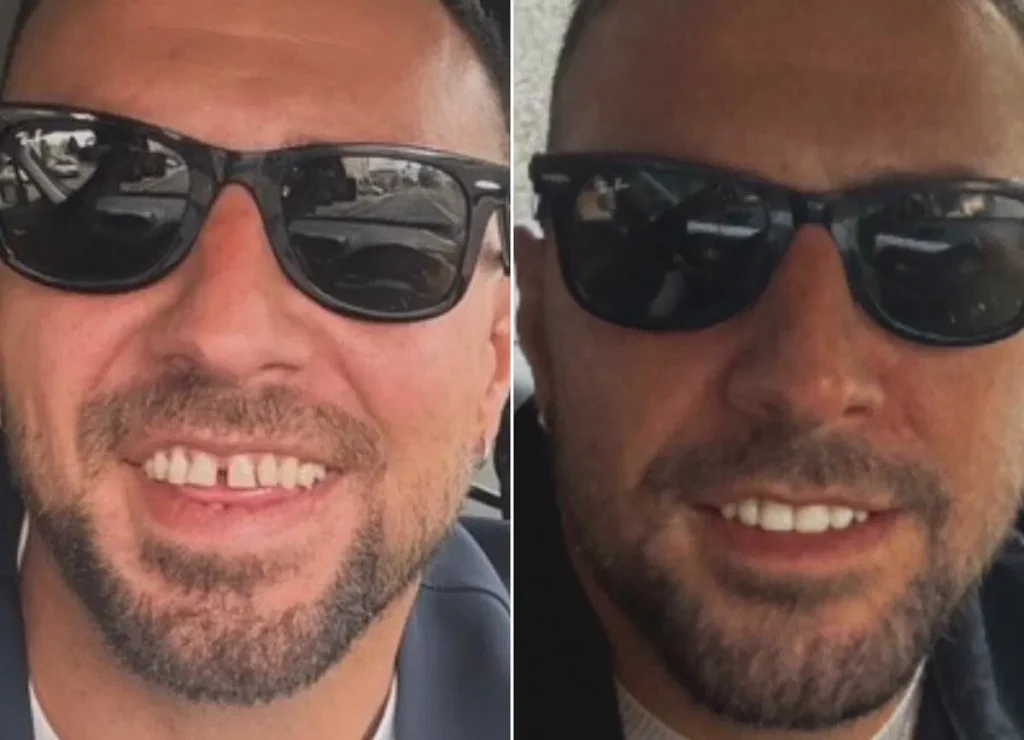 Temptation Island, Antonio si è rifatto i denti 3