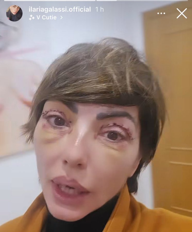 Grande Fratello, Ilaria Galassi mostra l’operazione estatica al vuso 2