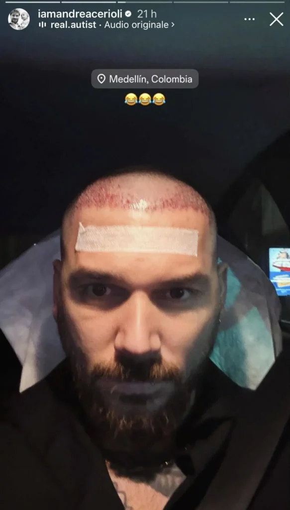 Uomini e donne, ex tronista si è sottoposto ad un trapianto, botox e liposuzione 3