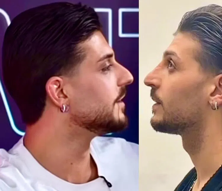 Uomini e donne, Ernesto si è sottoposto ad un intervento estetico 2