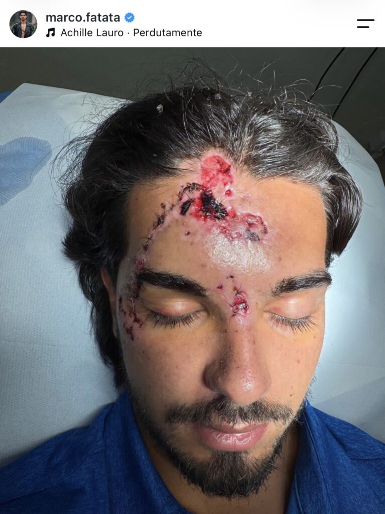 Temptation Island, il tentatore Marco vittima di un grave incidente 2