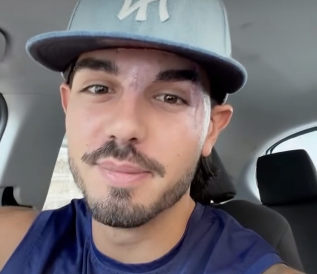 Temptation Island, il tentatore Marco si mostra dopo l’incidente 2