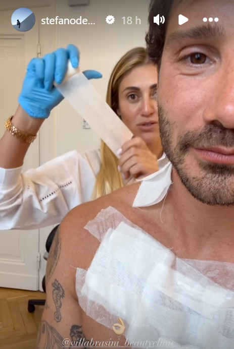 Stefano De Martino rimuove i tatuaggi 3